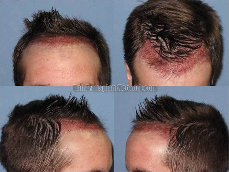 how to regrow dormant hair follicles